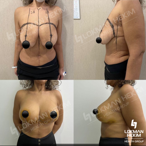 Mommy Makeover Surgery Before / After photo